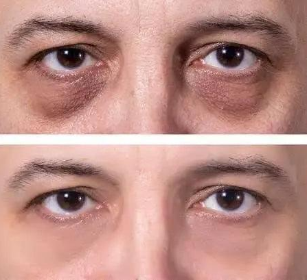 How to Remove Dark Circles under Eyes Permanently