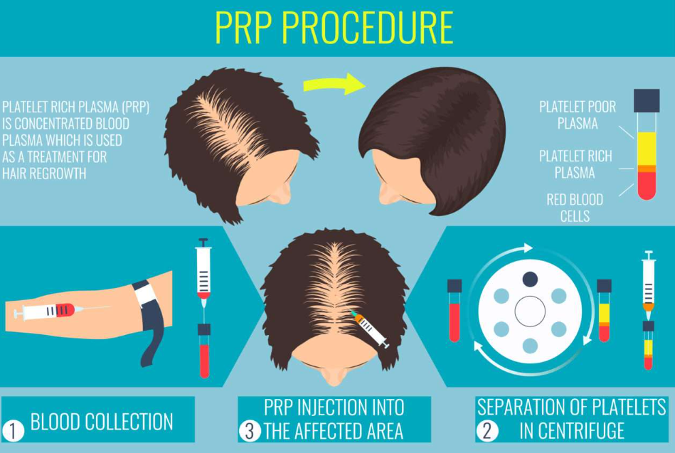 PRP Hair Treatment